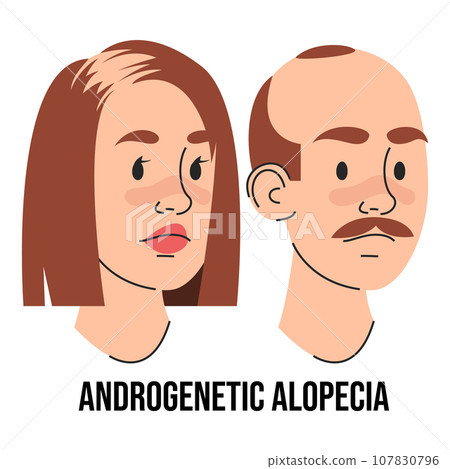 Androgenetic alopecia disease vector isolated 107830796