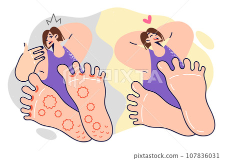 Woman with foot fungus before and after using medicinal ointment or seeing doctor 107836031