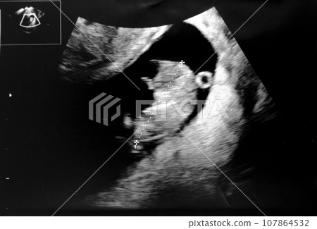 Echo picture of fetus at 9 weeks of pregnancy 107864532