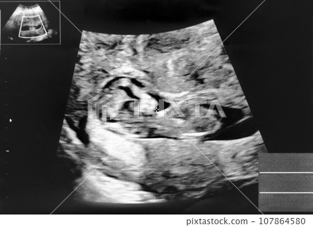 懷孕11週胎兒迴聲照片 107864580