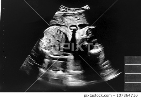 Echo photo of a fetus at 24 weeks pregnant Echo photo of a fetus at 24 weeks pregnant 107864710