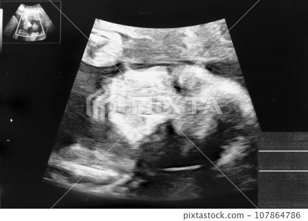 懷孕26週胎兒迴聲照片 懷孕26週胎兒迴聲照片 107864786