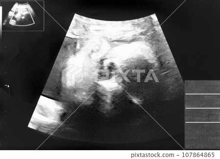 Echo photo of a fetus at 30 weeks pregnant 107864865