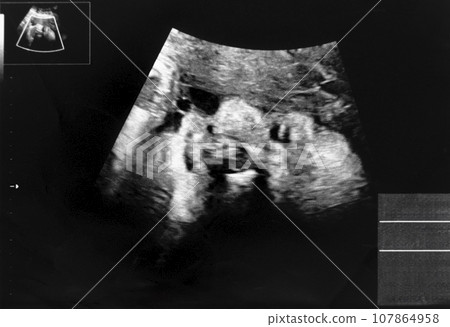 Echo photo of a fetus at 32 weeks pregnant 107864958