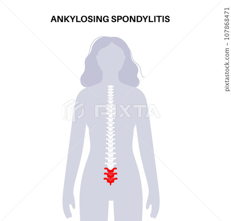 Ankylosing spondylitis disease Ankylosing spondylitis disease 107868471
