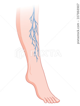 Varicose veins. Blue blood vessel visible through the skin, abnormally swollen leg. Vascular disease diagnostic and treatment. Venous insufficiency medical disease Varicose veins. Blue blood vessel visible through the skin, abnormally swollen leg. Vascular disease diagnostic and treatment. Venous insufficiency medical disease 107868987