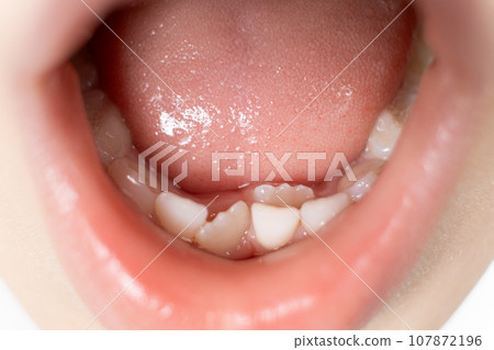 Crookedly growing teeth to replace milk teeth in a child. The second row of teeth, the tooth grows while the incisor has not yet fallen out. Crookedly growing teeth to replace milk teeth in a child. The second row of teeth, the tooth grows while the incisor has not yet fallen out. 107872196