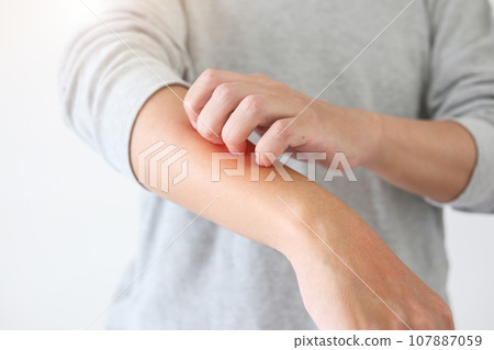 Young asian man itching and scratching on arm from itchy dry skin eczema dermatitis Young asian man itching and scratching on arm from itchy dry skin eczema dermatitis 107887059