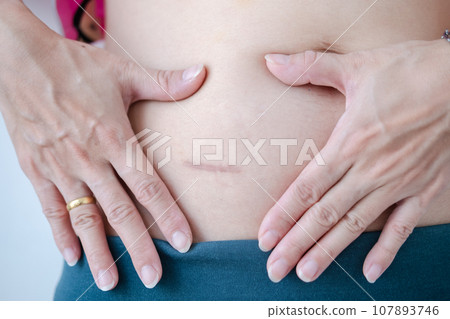 Close-up of scars after appendix surgery. 107893746