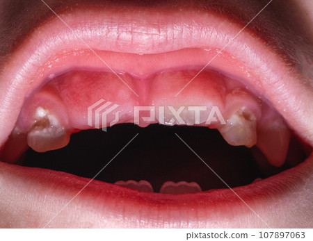 The eruption of a permanent tooth after the loss of a milk tooth in a child, close-up. Children's dentistry. 107897063