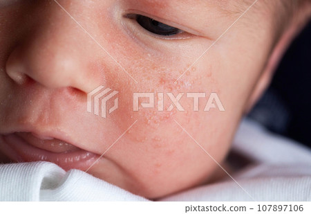 Allergic pimples in a newborn on the face. Pathogenesis, acne of newborns. Allergic pimples in a newborn on the face. Pathogenesis, acne of newborns. 107897106