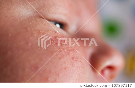 Rash on the face of a newborn baby. The process of formation of the hormonal system, close-up Rash on the face of a newborn baby. The process of formation of the hormonal system, close-up 107897117