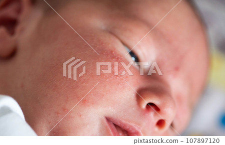 Rash on the face of a newborn baby. The process of formation of the hormonal system, close-up 107897120
