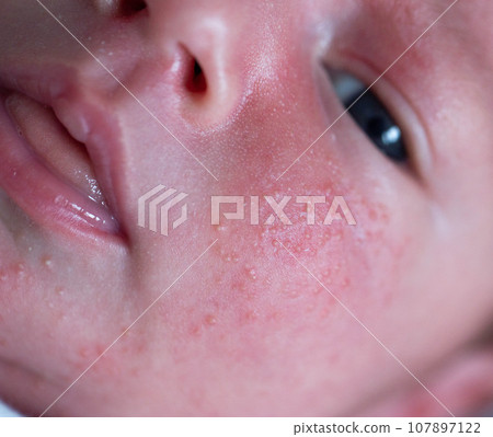 Pimples on the face of a newborn. Baby's adaptation to the environment, close-up Pimples on the face of a newborn. Baby's adaptation to the environment, close-up 107897122