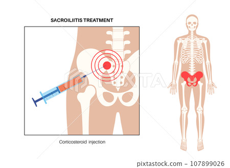 Sacroiliitis corticosteroid injections Sacroiliitis corticosteroid injections 107899026