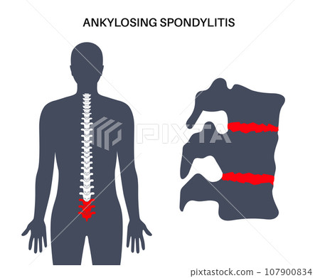 Ankylosing spondylitis disease Ankylosing spondylitis disease 107900834