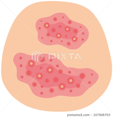 Skin with red eczema Skin disease Medical care 107906703