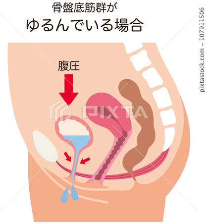 Loose pelvic floor muscles and urinary mechanism Urine leakage Health Loose pelvic floor muscles and urinary mechanism Urine leakage Health 107911506