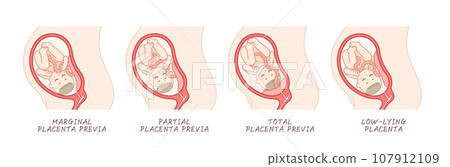 前置胎盤 前置胎盤 插圖 前置胎盤 前置胎盤 插圖 107912109
