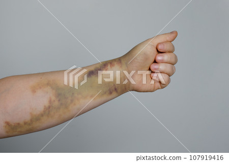 Car accident bruise on the woman's skin Car accident bruise on the woman's skin 107919416