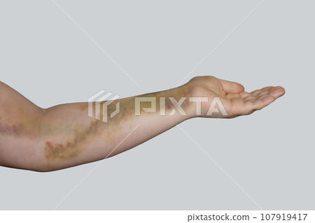 Car accident bruise trauma on female skin Car accident bruise trauma on female skin 107919417