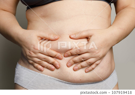 Women body with fat belly and stretch mark closeup Women body with fat belly and stretch mark closeup 107919418