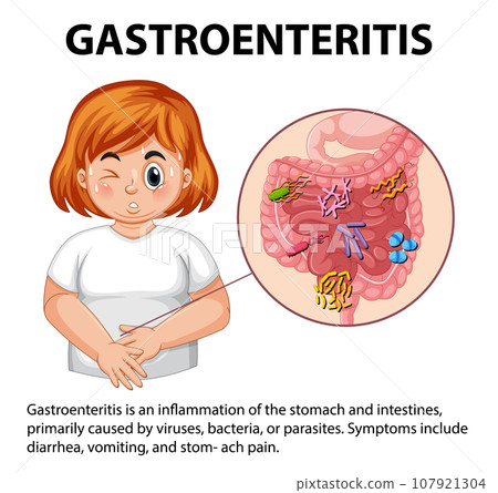 Chubby Woman with Gastroenteritis: Symptoms Infographic Chubby Woman with Gastroenteritis: Symptoms Infographic 107921304