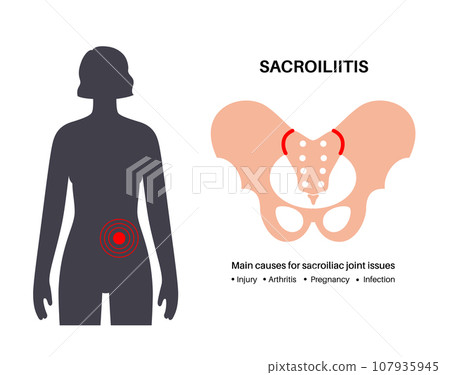 Sacroiliitis medical poster 107935945