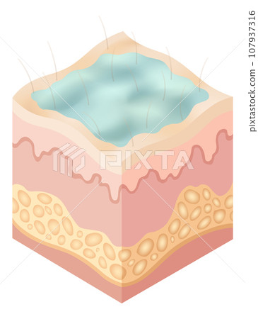 Protection uv ray skin. Illustration about Skin care concept. Sun protection body adipose layers epidermis, vector infographic 107937316