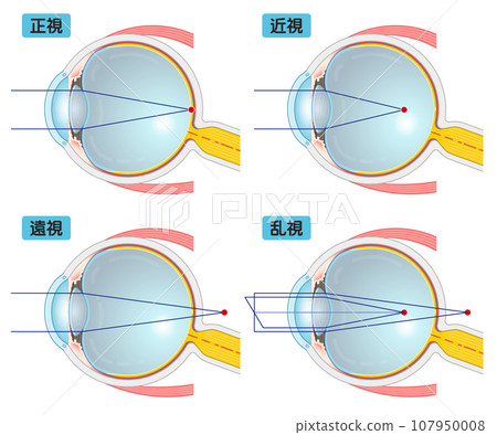 Illustrations/eye/illustration of eyeballs, myopia, farsightedness, presbyopia, and astigmatism 107950008