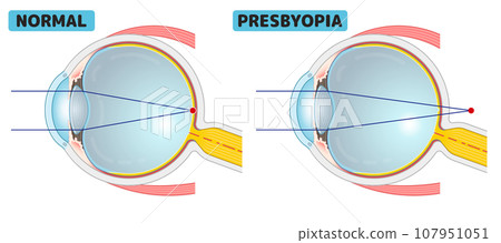 Eyeball, myopia, farsightedness, presbyopia, presbyopia, astigmatism, illustration/eye/illustration 107951051