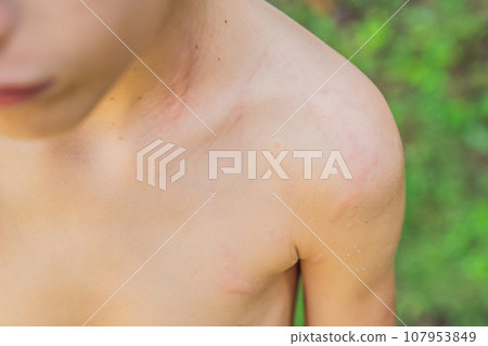 Instant pain: a boy's shoulder stung by a jellyfish. A vivid depiction of a painful encounter with marine life 107953849