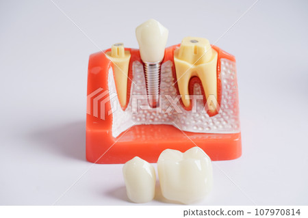 Dental implant, artificial tooth roots into jaw, root canal of dental treatment, gum disease, teeth model for dentist studying about dentistry. Dental implant, artificial tooth roots into jaw, root canal of dental treatment, gum disease, teeth model for dentist studying about dentistry. 107970814