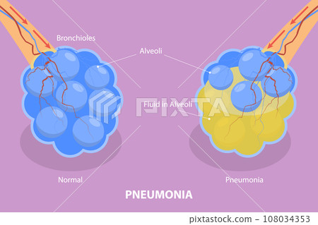 3D Isometric Flat Vector Illustration of Pneumonia 108034353