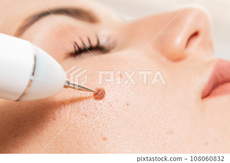 Microsurgery. Removal of birthmark from client's cheek with laser device. Close up. Concept of laser cosmelotogy and electrocoagulation Microsurgery. Removal of birthmark from client's cheek with laser device. Close up. Concept of laser cosmelotogy and electrocoagulation 108060832