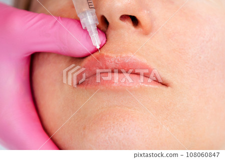 Lips augmentation procedure. Close-up female's face getting injection at beaty salon. Doctor in pink medical gloves with syringe injects filler in lips Lips augmentation procedure. Close-up female's face getting injection at beaty salon. Doctor in pink medical gloves with syringe injects filler in lips 108060847