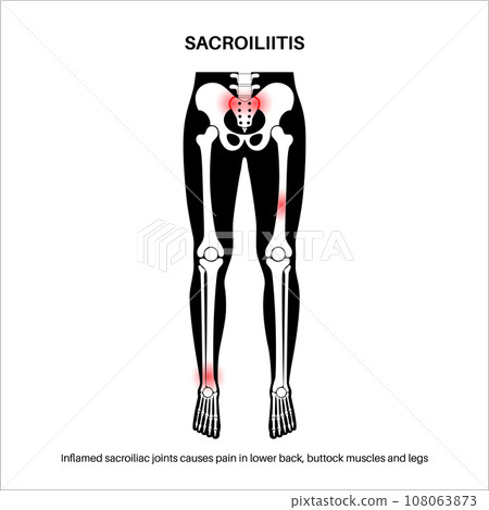 Sacroiliitis medical poster Sacroiliitis medical poster 108063873