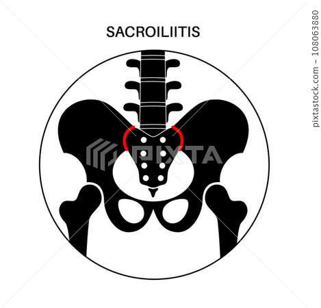 Sacroiliitis medical poster Sacroiliitis medical poster 108063880