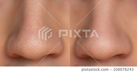 Nose before and after cleansing from black dots. Taking care of the health of the facial skin. Close-up. Acne on the nose. Nose before and after cleansing from black dots. Taking care of the health of the facial skin. Close-up. Acne on the nose. 108078243