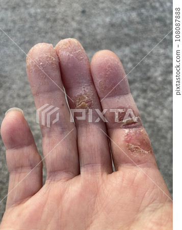 由於寵物過敏和帶狀皰疹惡化而導致的異位性皮膚炎患者的皮膚撕裂、手部濕疹/乾裂以及自體免疫疾病。 108087888