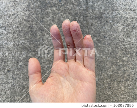 由於寵物過敏和帶狀皰疹惡化而導致的異位性皮膚炎患者的皮膚撕裂、手部濕疹/乾裂以及自體免疫疾病。 108087896