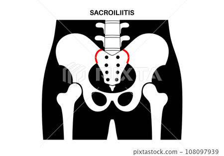 Sacroiliitis medical poster Sacroiliitis medical poster 108097939