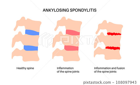 Ankylosing spondylitis disease 108097943