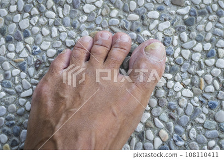 Toenails with fungus problems on gray stone background 108110411