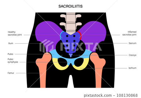 Sacroiliitis medical poster Sacroiliitis medical poster 108130868