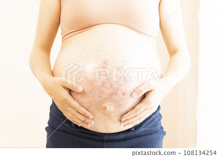 Pregnant woman putting her hand on her stomach with stretch marks and midline 108134254