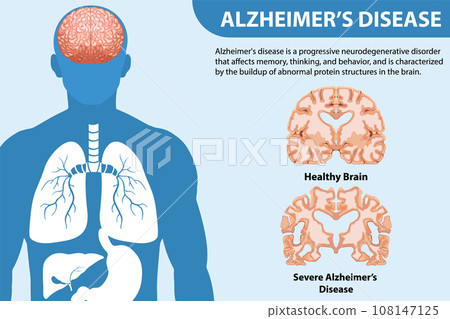 Informative poster of Alzheimers disease 108147125