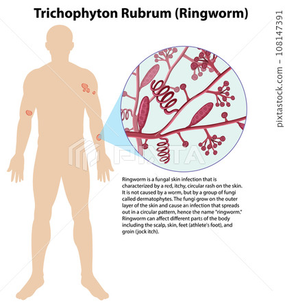 Trichophyton Rubrum fungal infection Trichophyton Rubrum fungal infection 108147391