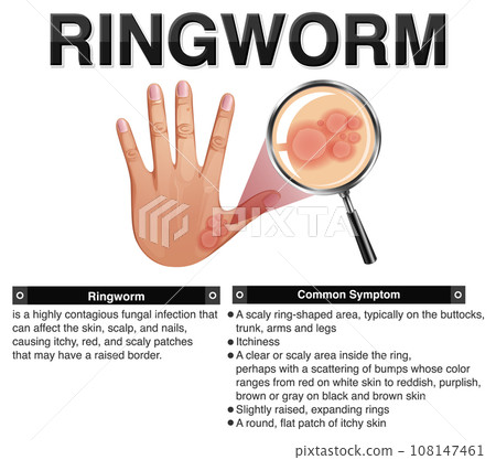 Informative symptoms of Ringworm 108147461