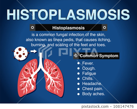 Informative poster of Histoplasmosis Informative poster of Histoplasmosis 108147476